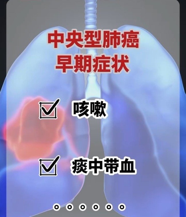 医生：肺癌不是只有烟民才会得 早期筛查至关重要  第1张