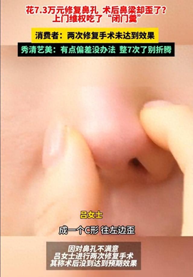 女子花数万修复鼻孔却被弄歪鼻梁 美容变“毁容”  第1张